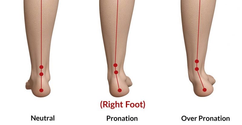 Over pronation