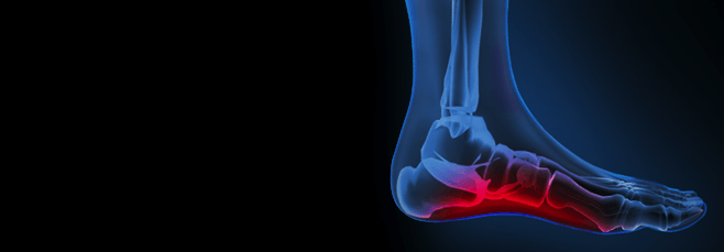 high arch underpronation